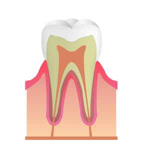 初期のむし歯