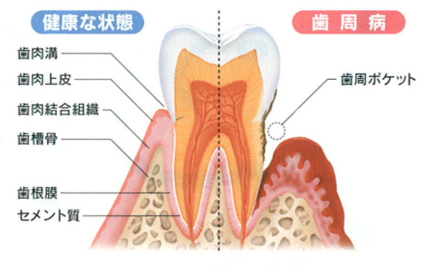 歯周ポケットと歯の喪失の関係 | 山下浩歯科医院